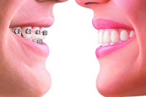 &iquest;Qu&eacute; Pasa Si No Me Gustan los Brackets?