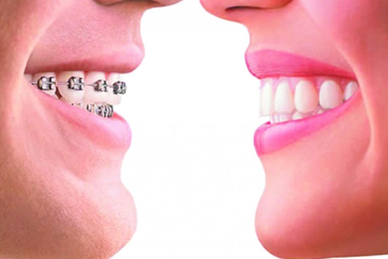 &iquest;Qu&eacute; Pasa Si No Me Gustan los Brackets?